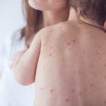 Is the Chicken Pox Vaccine Necessary for Babies?